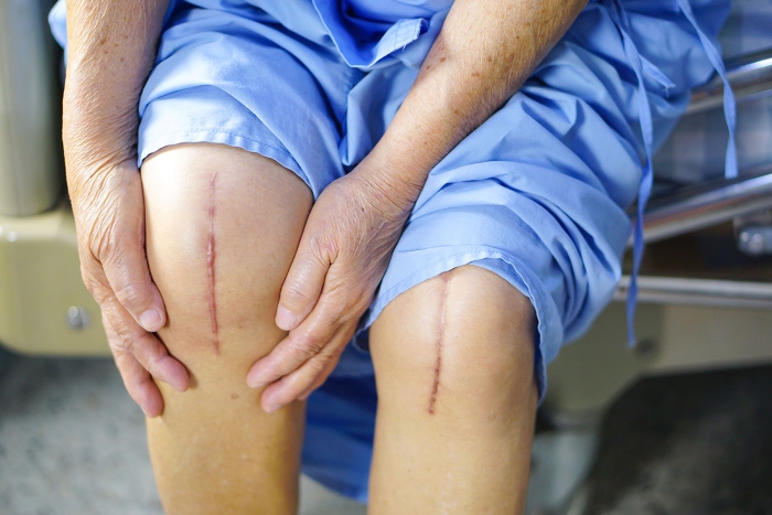 Plan your Post -Op recovery by booking your Physiotherapy Pre-Op